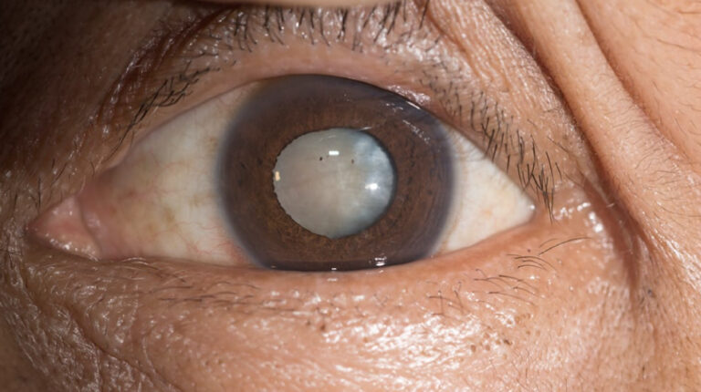 What Causes Cataracts, and How to Help Prevent Them